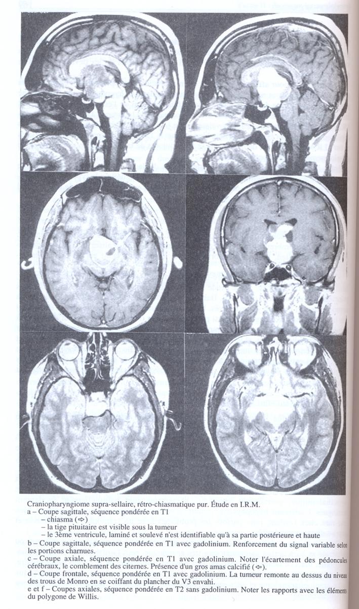 http://campus.neurochirurgie.fr/IMG/jpg/Page170_16_1.jpg