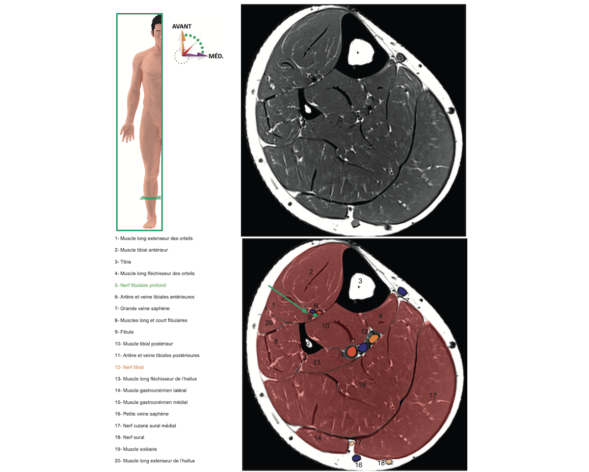 10.1.3.6 Le nerf fibulaire - Campus de Neurochirurgie