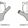 Figure 3 : Dissection minimale vs dissection totale de l'anévrisme. (…)