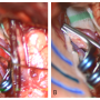 Figure 5 : Clippage face à face (A) - Clippage en tandem (B)